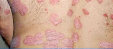 Skin Diseases Treatment in Chennai | ID: 14752724088