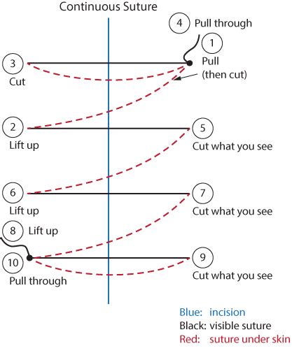 4.4 Suture Removal – Clinical Procedures for Safer Patient Care