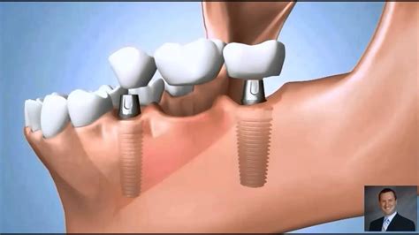 Two Implant Fixed Bridge | Dental Implant Bridge - YouTube