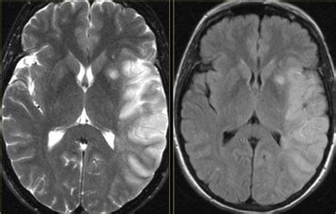 Stroke Brain Mri