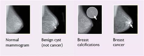 Breast Changes and Conditions - NCI