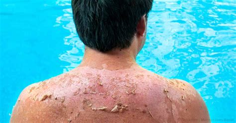 Sunburn – Discover Natural Sunburn Treatment and Remedies