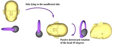 Frontiers | Case Report: New Application of a Gufoni Maneuver Variation ...