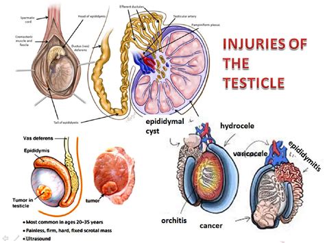 Epididymal Head Cyst