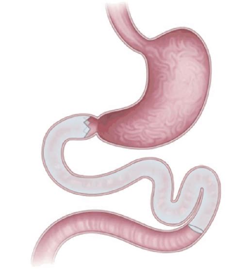 Duodenal-jejunal bypass liner. Source: Gong and Kim. 40 | Download Scientific Diagram