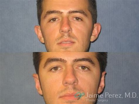 Ear Pinning, Ear Surgery, and Otoplasty by Jaime Perez, M.D. - Ear ...