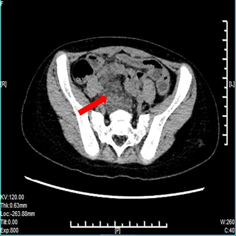 -A ruptured appendix with exudate mass flowed into the abdominal ...