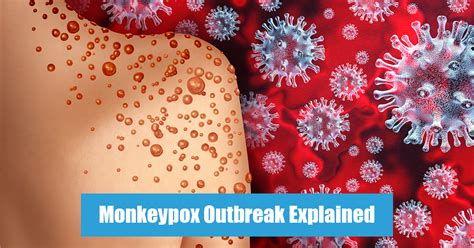 Monkeypox Outbreak Explained: Symptoms, Treatment & More: UPSC Current Affairs
