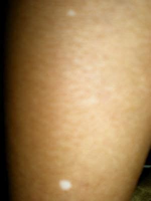 Unexplained White Spots on Your Skin? This Could Be Why | White skin ...