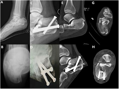 A 19-year-old female patient who fell from a height, resulting in a ...