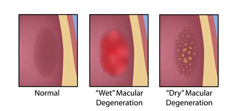 Macular Degeneration Treatment in California | AMD