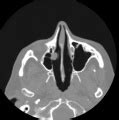 Nasal polyp - wikidoc