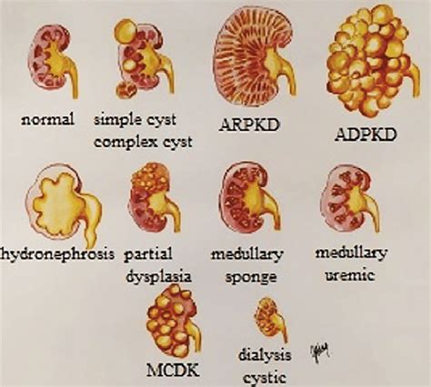 Kidney Size Chart For Renal Cyst