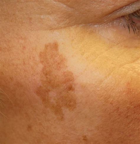 Age spots: Causes, symptoms, and treatment