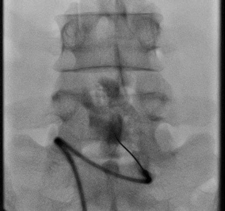 Superior hypogastric nerve block | Image | Radiopaedia.org