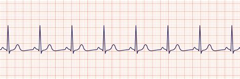 ACLS Rhythm Strips Training and Interpretation