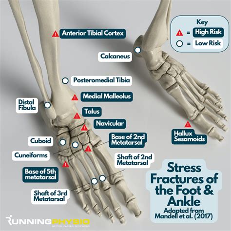 Stress fractures of the foot & ankle [infographic] - Dosje