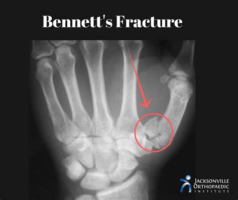 Bennett's Fracture: Break At The Base of Your Thumb