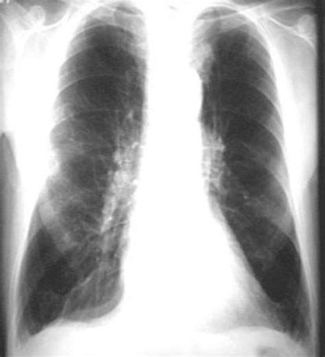 Emphysema - Causes, Signs, Symptoms, Stages, Expectancy & Treatment