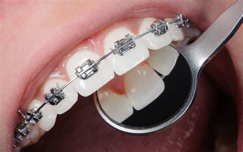 All That You Need To Know About Orthodontic Treatment - The Mind Blown