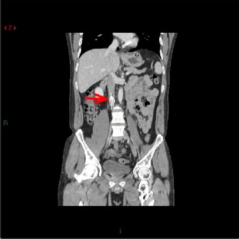 CT coronal slice showing IVC filter in place post 5 years. | Download Scientific Diagram