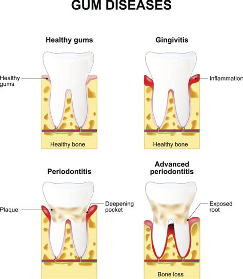 Gum Disease FAQs Plano TX | Periodontal Treatment Dallas