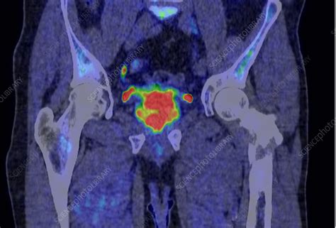 Prostate cancer, CT-PET scan - Stock Image - C048/2988 - Science Photo Library