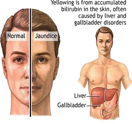 Gilbert's Syndrome - Physiopedia