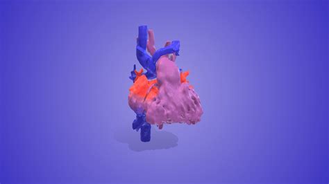 HLHS post Glenn Surgery - Download Free 3D model by 3D Heart Project ...