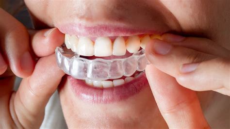 Invisalign and Fixing Overbites: How it Works, Timeline and More