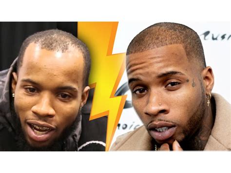 Tory Lanez Hair Transplant - Best Hair Transplant Services In Town!