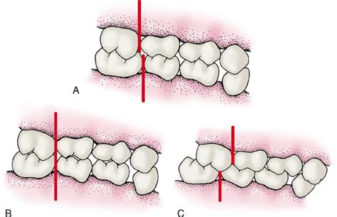 6: Occlusion | Pocket Dentistry