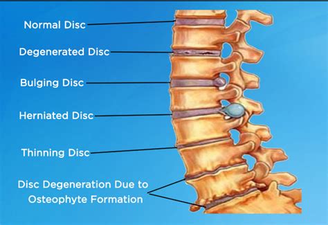 Lumbar Laminectomy Surgery: Procedure, Risks And Recovery, 43% OFF