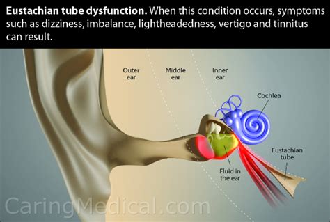 Eustachian Tube Dysfunction Remedies