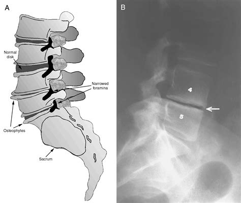 Osteophytes Lumbar