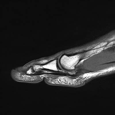 Radiology Cases: Plantar Plate Tear