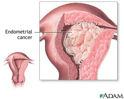 InterActive Health - Endometrial Cancer