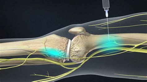 Genicular Knee Nerve Block Injection Houston & Victoria TX