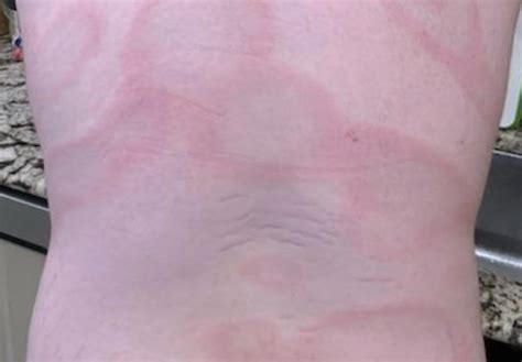 Disseminated erythema migrans as a result of Lyme disease