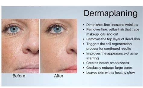 Dermaplaning - Acne, Scars & Facial Spots - SkinWonder Medi Spa - Beauty Parlour | Calgary