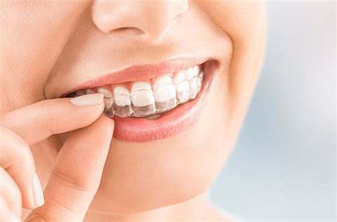 Invisalign near me | Dentist in Lyndhurst, Mayfield, Cleveland, Ohio