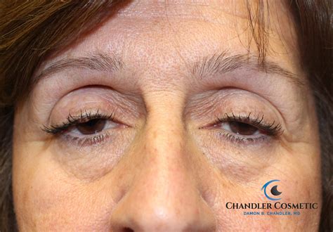 Identifying and Correcting Ptosis (Droopy Eyelids)