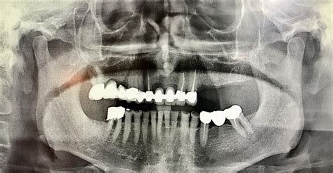 Implant dentaire à Barbizon - Dentiste Fontainebleau - Implant Melun