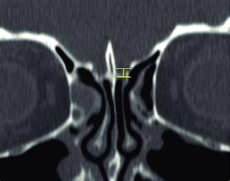 Depth of the cribriform plate: measured as the vertical height of the... | Download Scientific ...