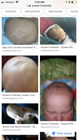 Sunken Fontanelle? | BabyCenter