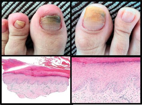 Onycholysis: clinicalhistopathologic correlations. Persistent... | Download Scientific Diagram