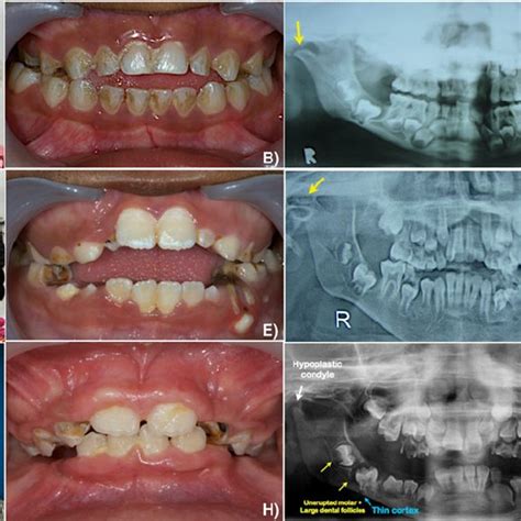 (PDF) Oral manifestations of 17 patients affected with mucopolysaccharidosis type VI