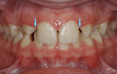 What is the difference between hyperdontia, hypodontia, oligodontia and anodontia? | News ...