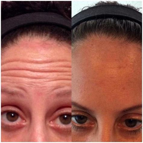 Botox Before And After Pictures Forehead (4) » Facelift: Info, Prices ...