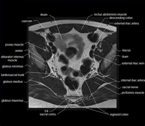 MRI pelvis Anatomy | Free Male Pelvis Axial Anatomy